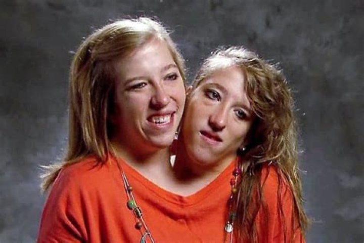 Conjoined Twins Abby and Brittany: A Remarkable Journey of Unity and Resilience