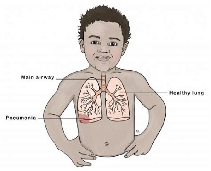 P Diddy Pneumonia: Understanding the Health Condition and Its Implications
