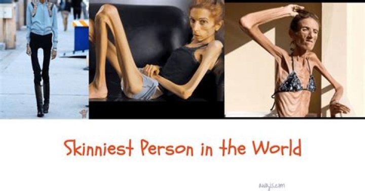 Skinniest People in the World: Unveiling the Stories Behind Extreme Thinness