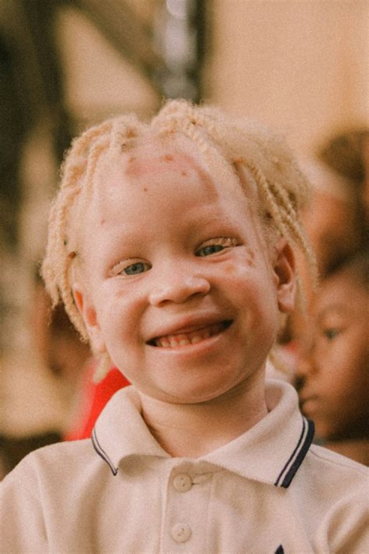 The World&rsquo;s Whitest Person: Exploring the Phenomenon of Albinism and Beyond