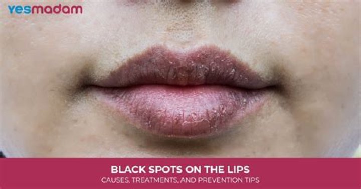 Understanding White Spots on Lips: Causes, Treatments, and Prevention